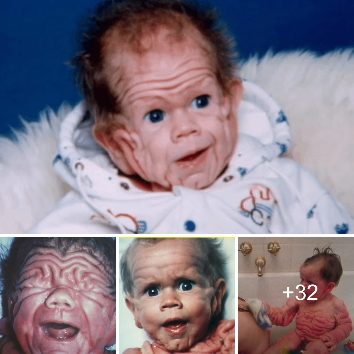 A Baby Born With Wrinkled Skin Resembling That Of A 70 year old Man a-baby-born-with-wrinkled-skin-resembling-that-of-a-70-year-old-man