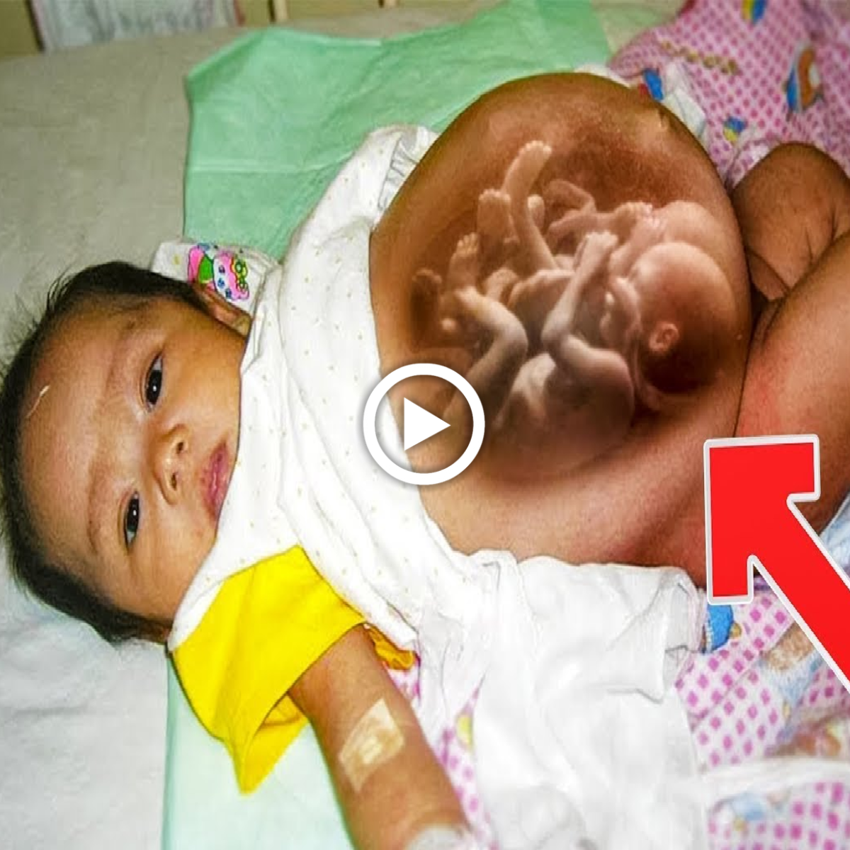 Astonishing Miracle: A Baby Girl Born with Twins Inside Her Belly and a ...